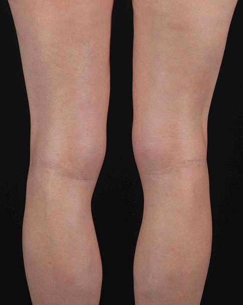 Quantum Rf Before & After Patient #925