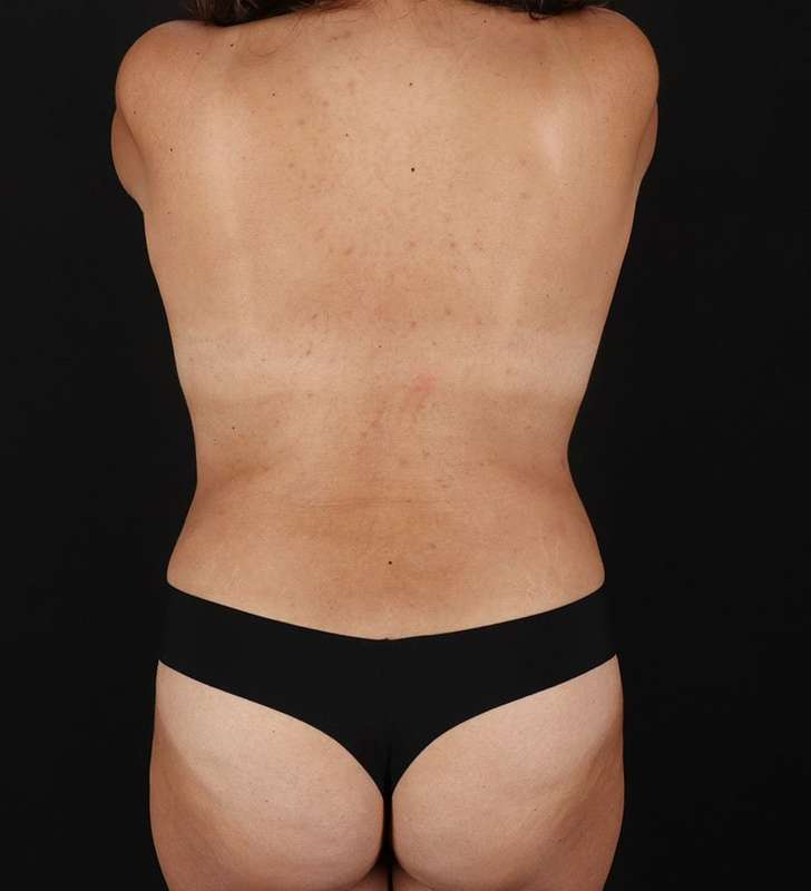 Tummy Tuck Before & After Patient #2352