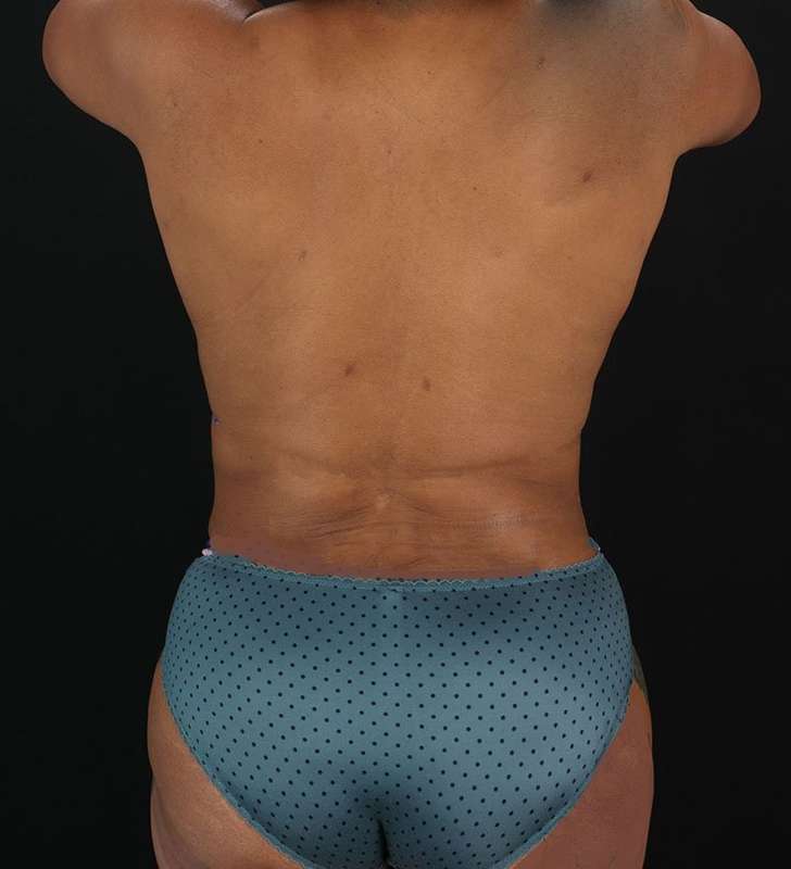 Tummy Tuck Before & After Patient #2402