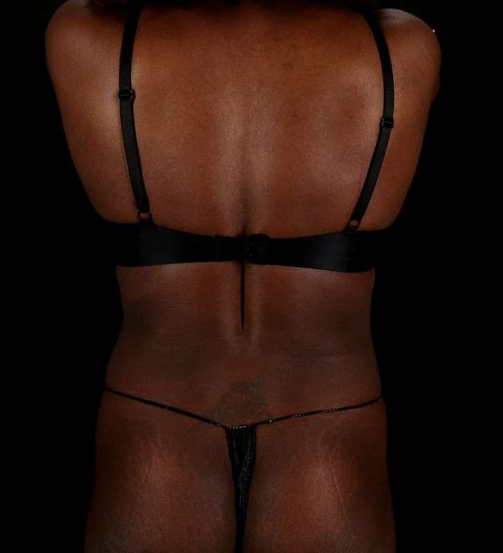 Tummy Tuck Before & After Patient #2448