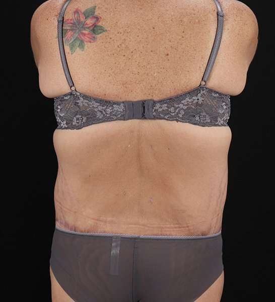 Circumferential Body Lift Before & After Patient #2509