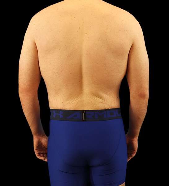 Circumferential Body Lift Before & After Patient #2522