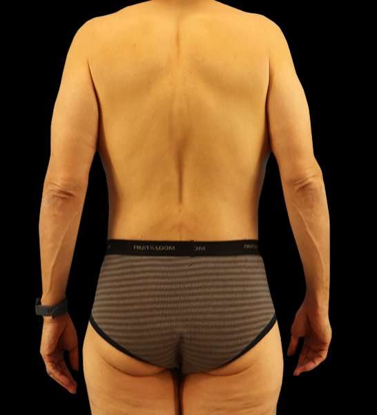 Circumferential Body Lift Before & After Patient #2535