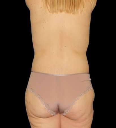 Circumferential Body Lift Before & After Patient #2559