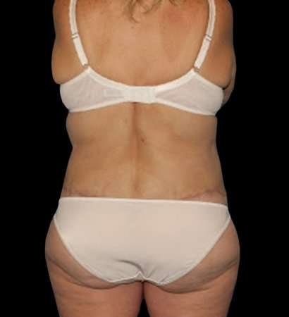 Circumferential Body Lift Before & After Patient #2572