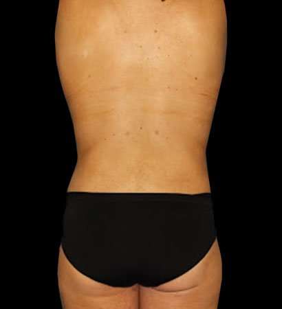 Circumferential Body Lift Before & After Patient #2585