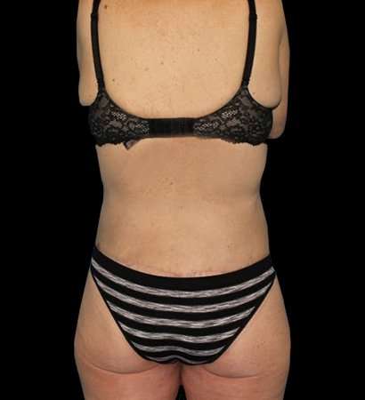 Circumferential Body Lift Before & After Patient #2598