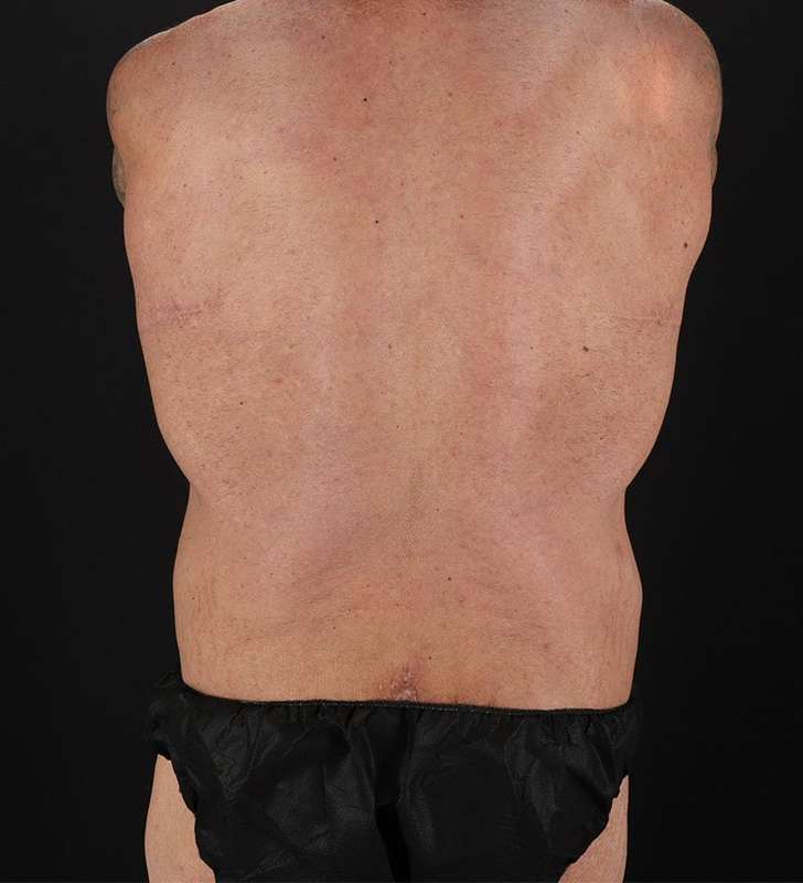 Circumferential Body Lift Before & After Patient #2611
