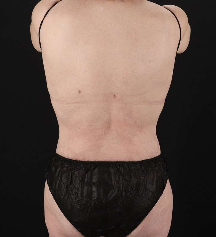 Circumferential Body Lift Before & After Patient #2624