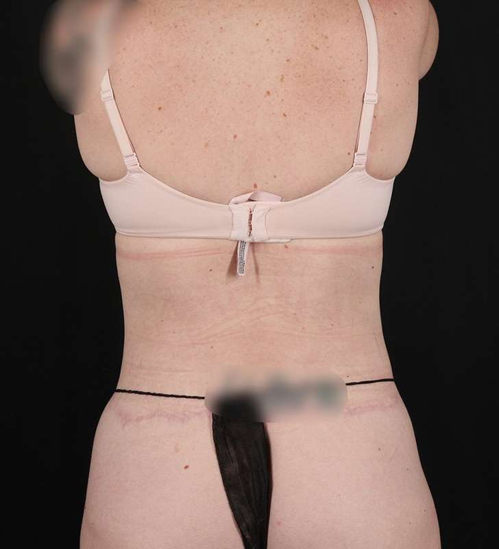 Circumferential Body Lift Before & After Patient #2650