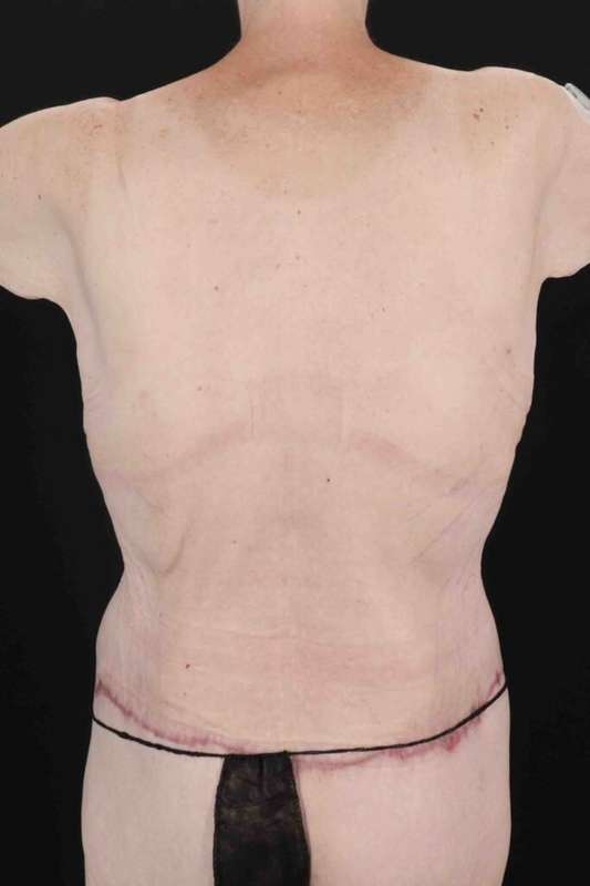 Circumferential Body Lift Before & After Patient #2663