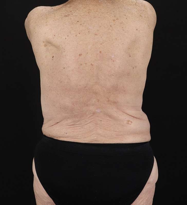 Fleur De Lis Tummy Tuck Before & After Patient #2727