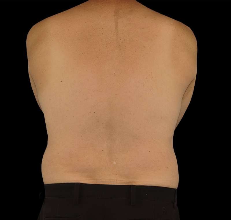 Liposuction Before & After Patient #2756