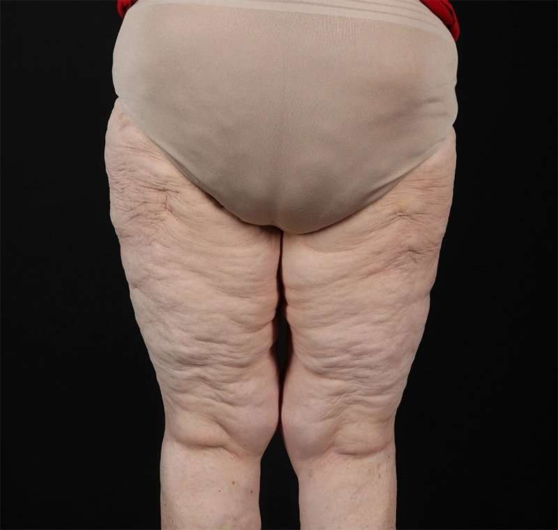 Liposuction Before & After Patient #2829