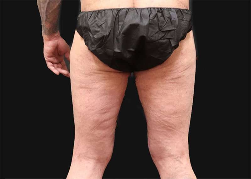 Thigh Lift Before & After Patient #2992