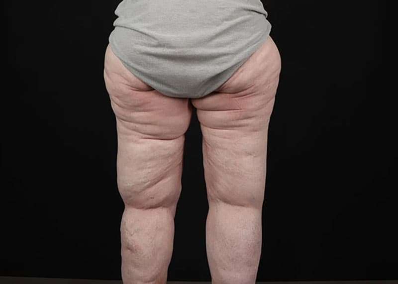 Thigh Lift Before & After Patient #3005
