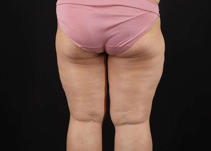 Thigh Lift Before & After Patient #3018