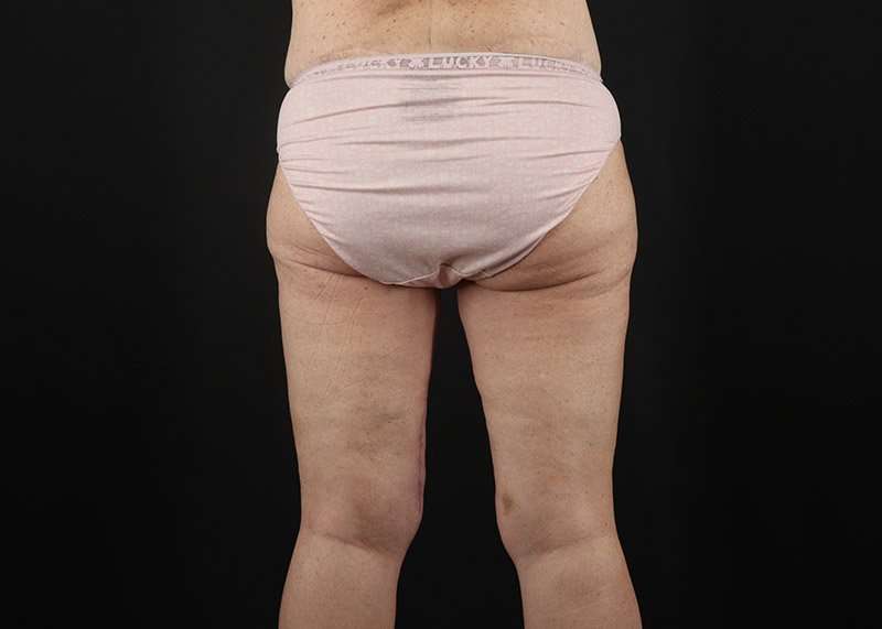 Thigh Lift Before & After Patient #3031