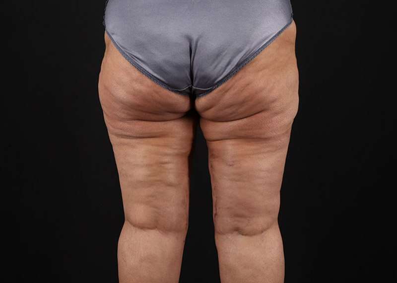 Thigh Lift Before & After Patient #3044