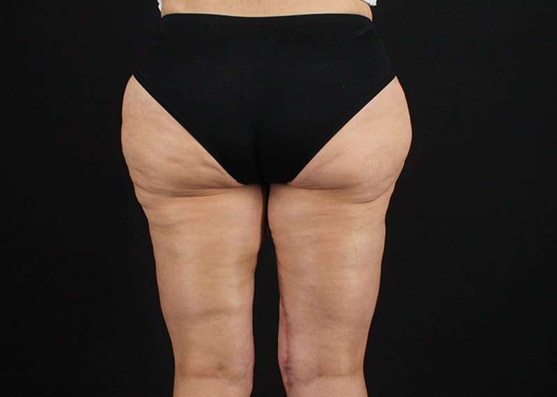 Thigh Lift Before & After Patient #3057