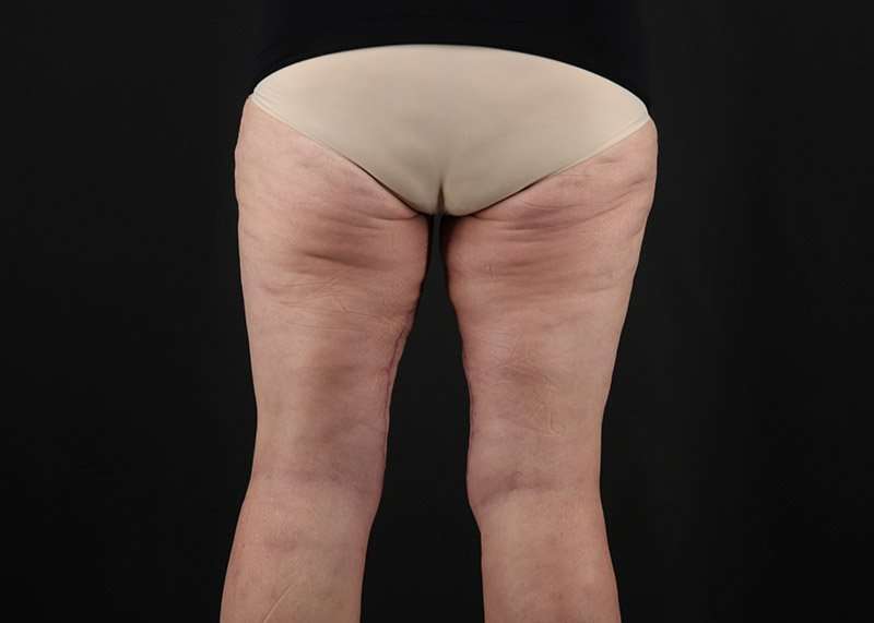 Thigh Lift Before & After Patient #3070