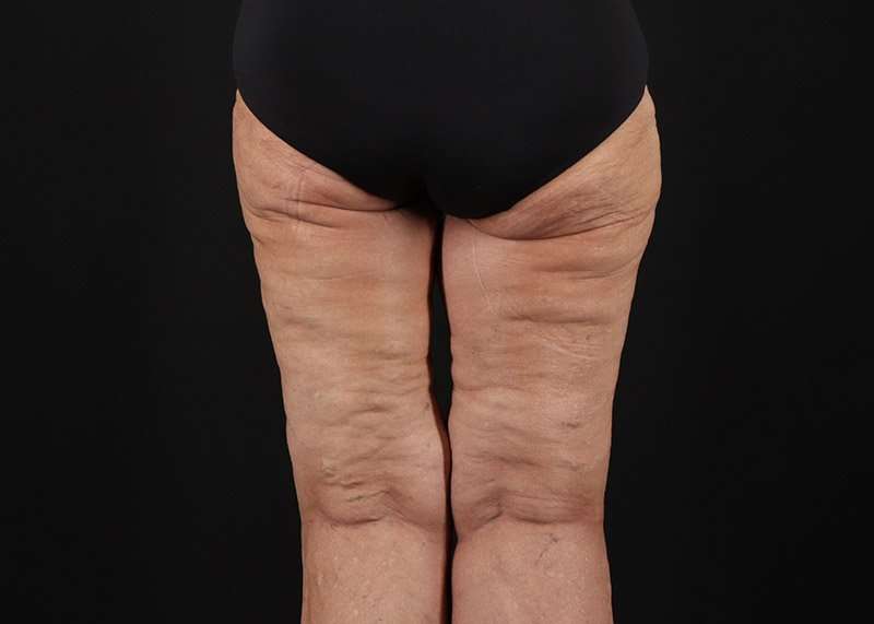 Thigh Lift Before & After Patient #3083