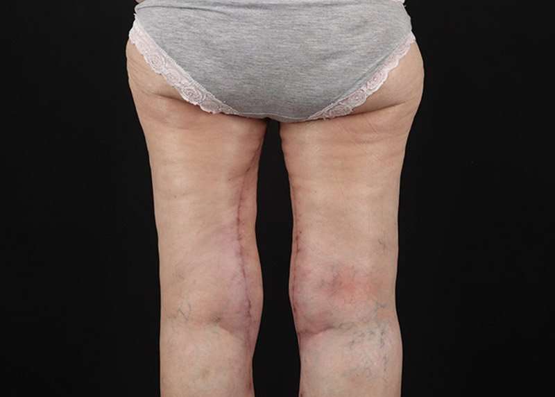 Thigh Lift Before & After Patient #3096