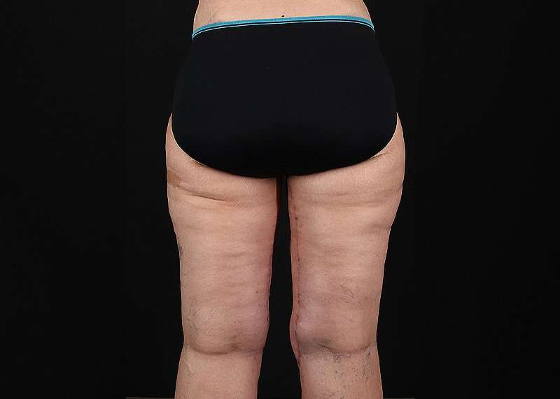 Thigh Lift Before & After Patient #3109