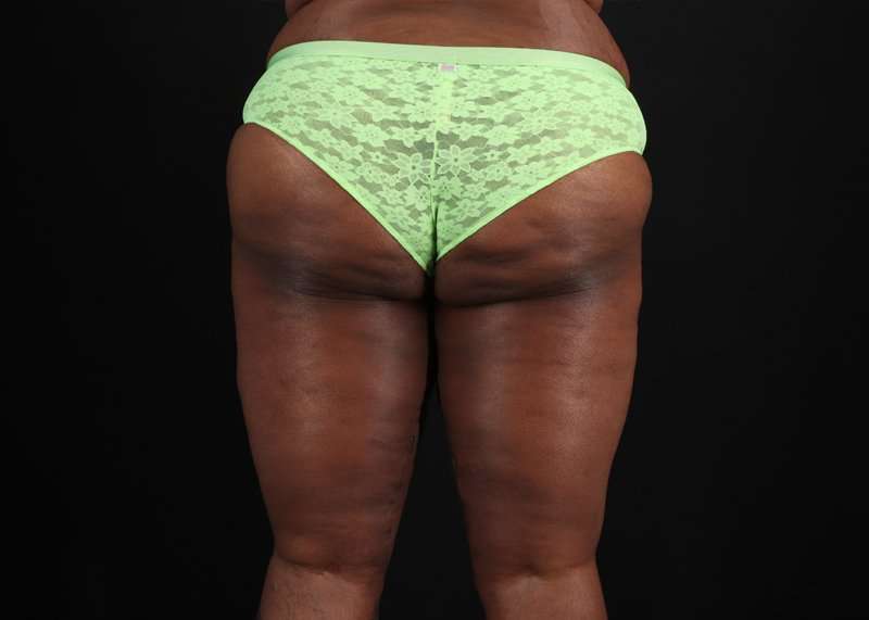 Thigh Lift Before & After Patient #3122