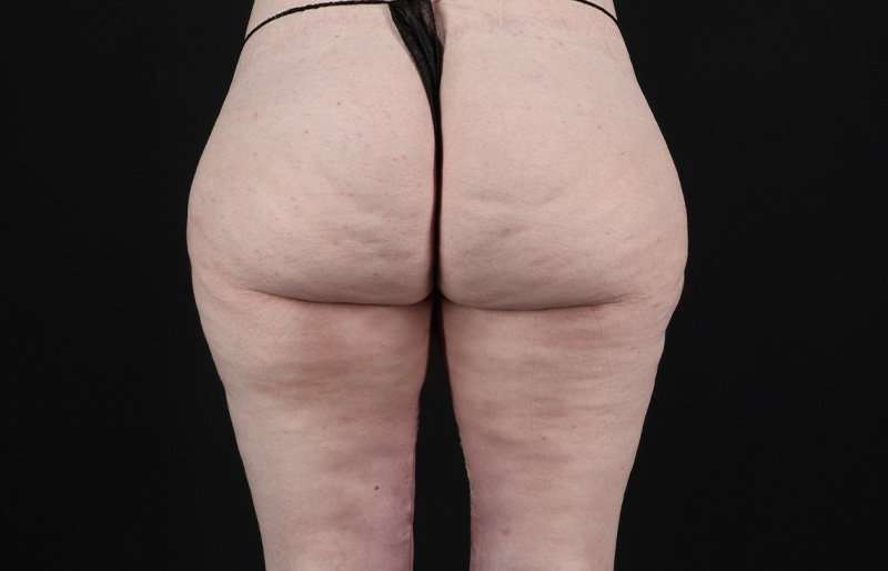Thigh Lift Before & After Patient #3135