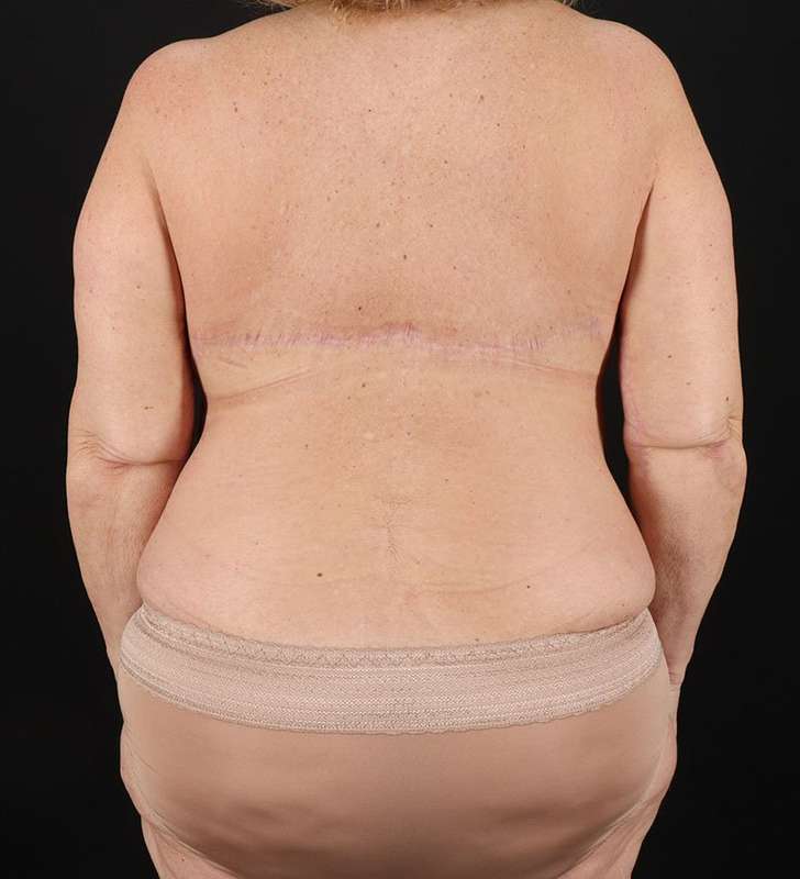 Tummy Tuck Revision Before & After Patient #3181