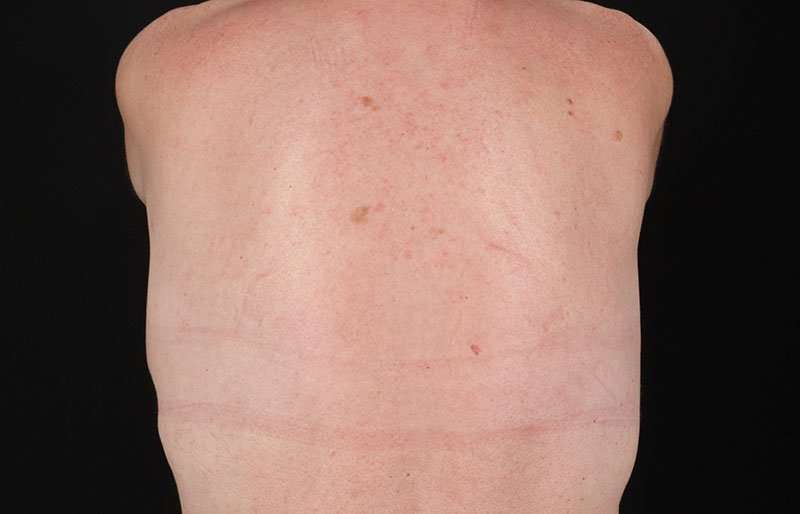 Breast Augmentation - Fat Transfer Before & After Patient #1557