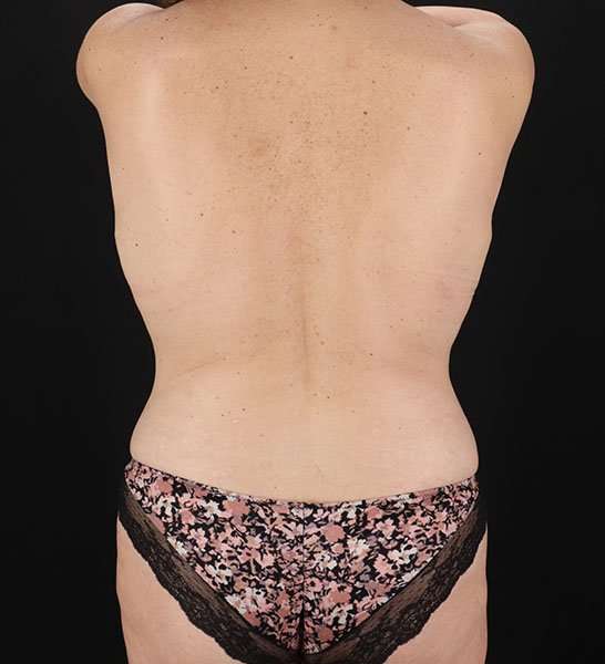 Tummy Tuck Before & After Patient #2247