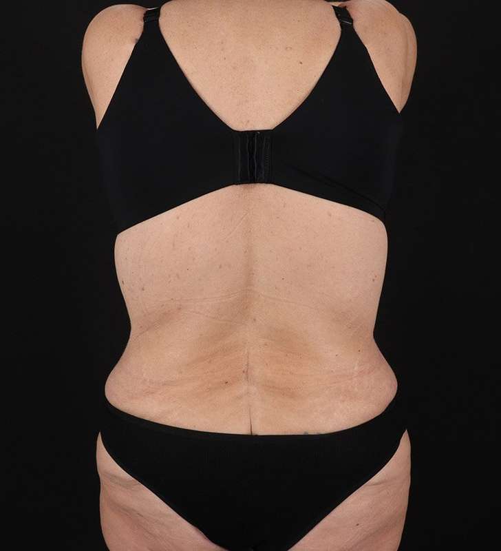 Tummy Tuck Before & After Patient #2326