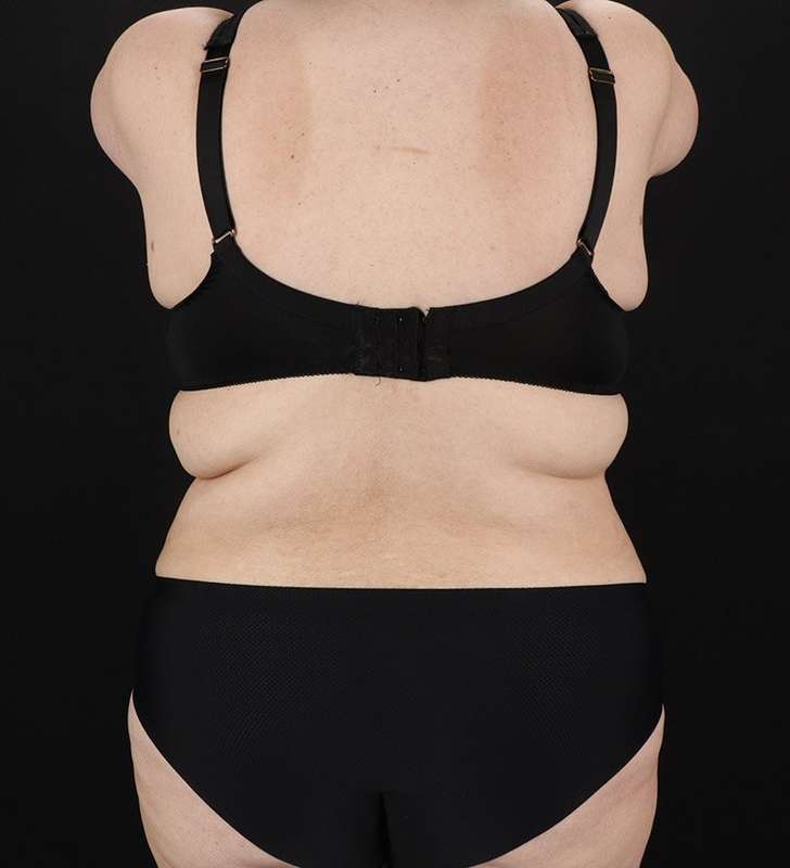 Tummy Tuck Before & After Patient #2339