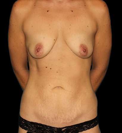 Breast Augmentation - Implant Before & After Patient #979