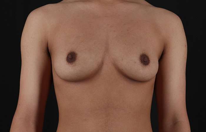 FTM Chest Contouring Before & After Patient #1929