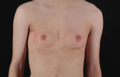 FTM Chest Contouring Before & After Patient #1940