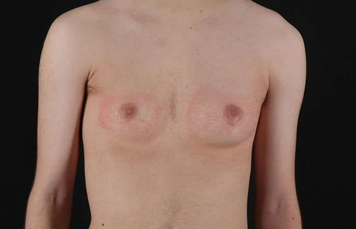 FTM Chest Contouring Before & After Patient #1940