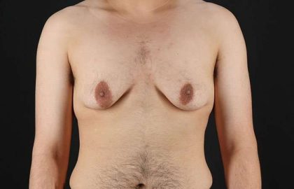 FTM Chest Contouring Before & After Patient #1951
