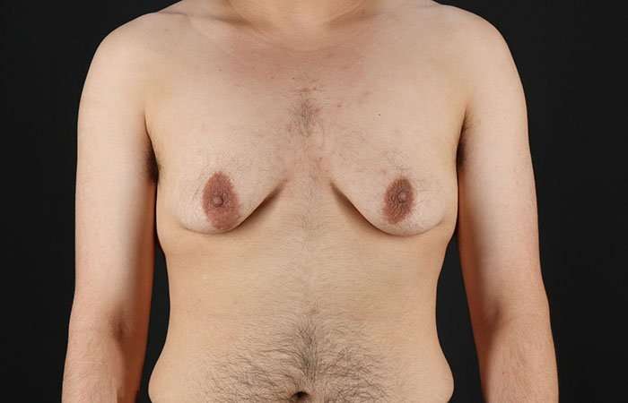 FTM Chest Contouring Before & After Patient #1951