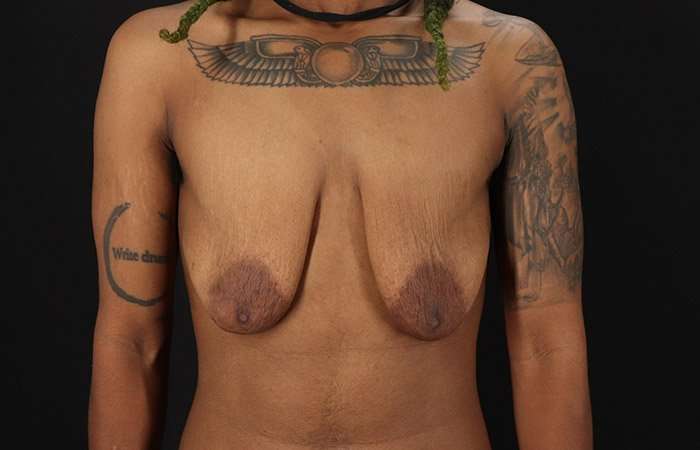FTM Chest Contouring Before & After Patient #1962