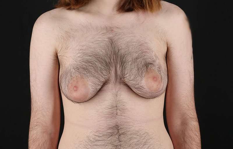 FTM Chest Contouring Before & After Patient #1984