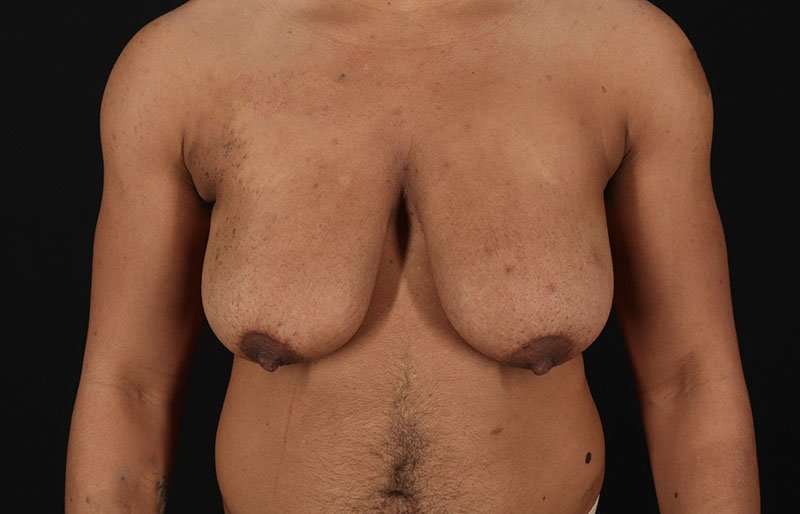 FTM Chest Contouring Before & After Patient #1995