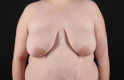FTM Chest Contouring Before & After Patient #2006