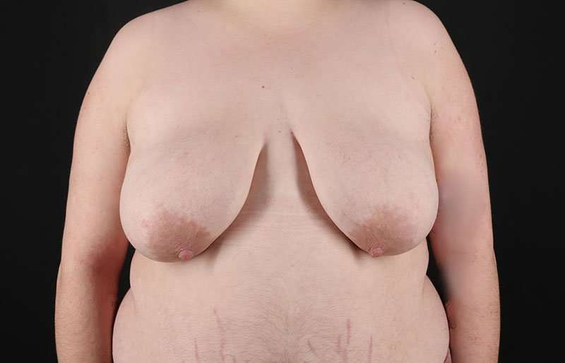 FTM Chest Contouring Before & After Patient #2006