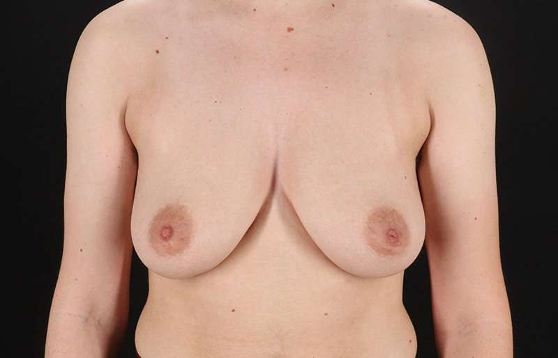 FTM Chest Contouring Before & After Patient #2017