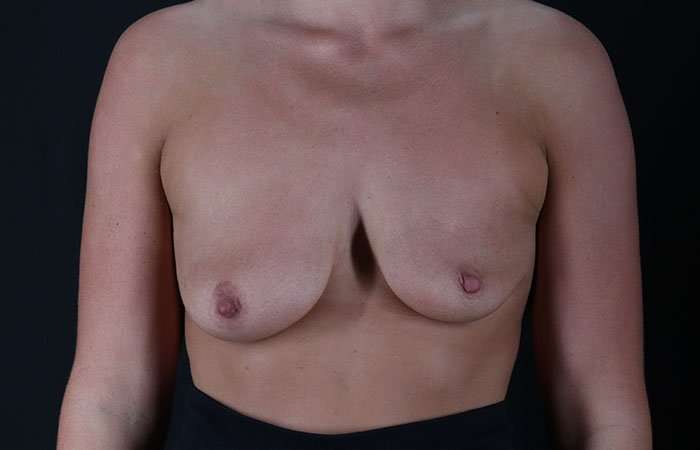 Breast Augmentation - Implant Before & After Patient #990