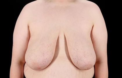 FTM Chest Contouring Before & After Patient #2039