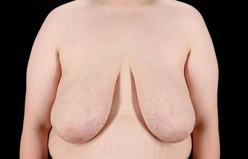 FTM Chest Contouring Before & After Patient #2039